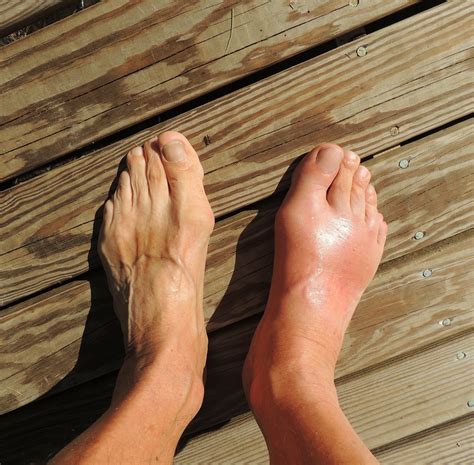 Finding Relief From the Pain of Gout: What You Should Know About Symptoms and Treatment of Gout in Your Feet